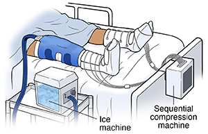 Patient in hospital bed with cuff around knee attached to ice machine, and sequential compression sleeves on feet and calves.